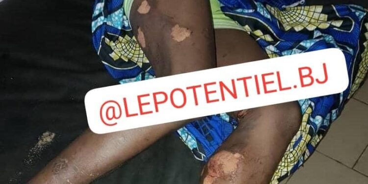 Incendie criminel dans le département des Collines: Par jalousie et haine, un homme brûle une maison remplie d’arachides à Glazoué